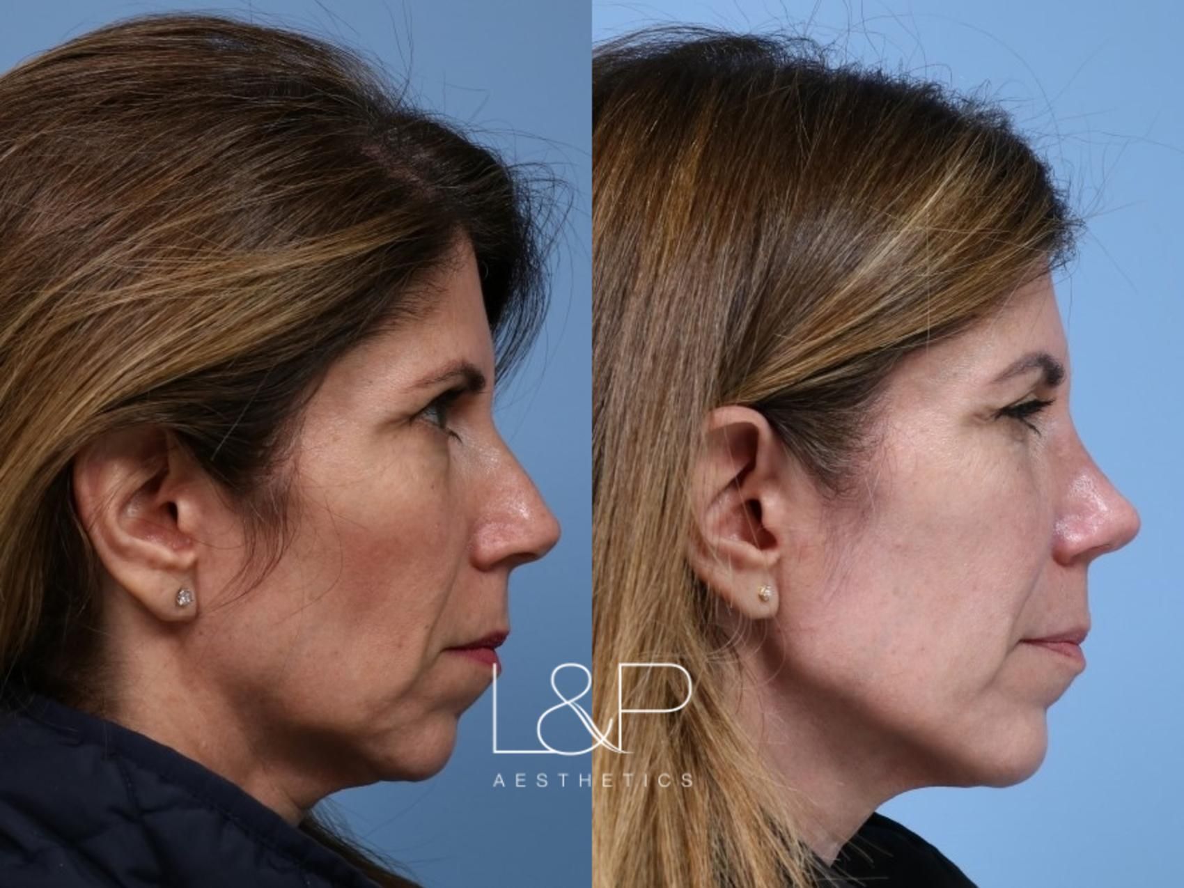 Rhinoplasty before and after treatment in Los Gatos, California